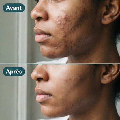 SOPK Balance+ Équilibre Hormonal, Cycles Réguliers et Peau Plus Nette
