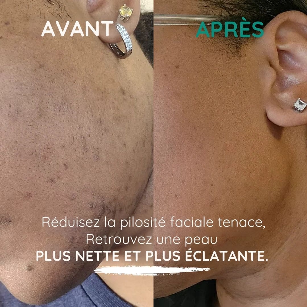 SOPK Balance+ Équilibre Hormonal, Cycles Réguliers et Peau Plus Nette